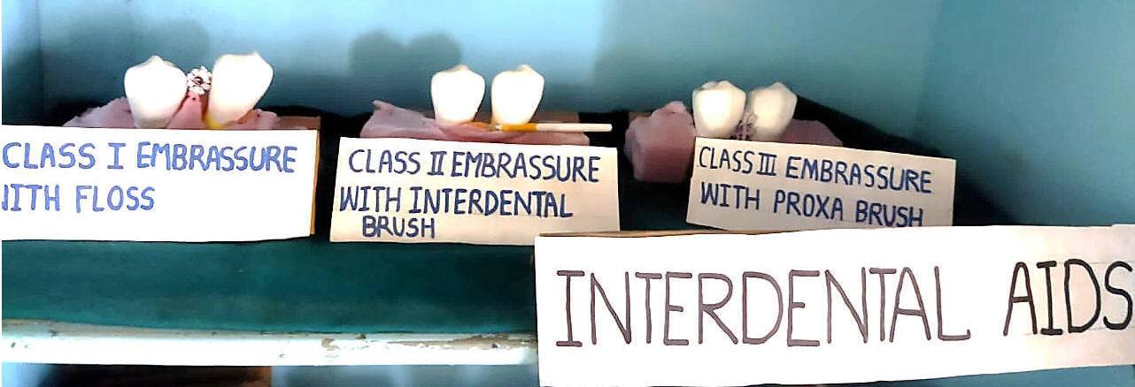 Classification of Internal Papillary Heights(Nordland& Tarnow)